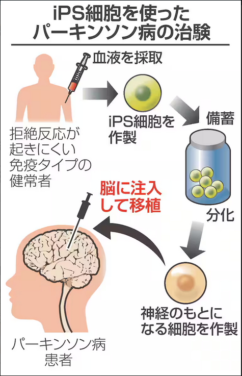 IPS-Parkinson.PNG